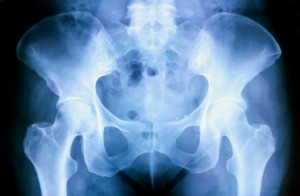 Picture of a hip X-ray.